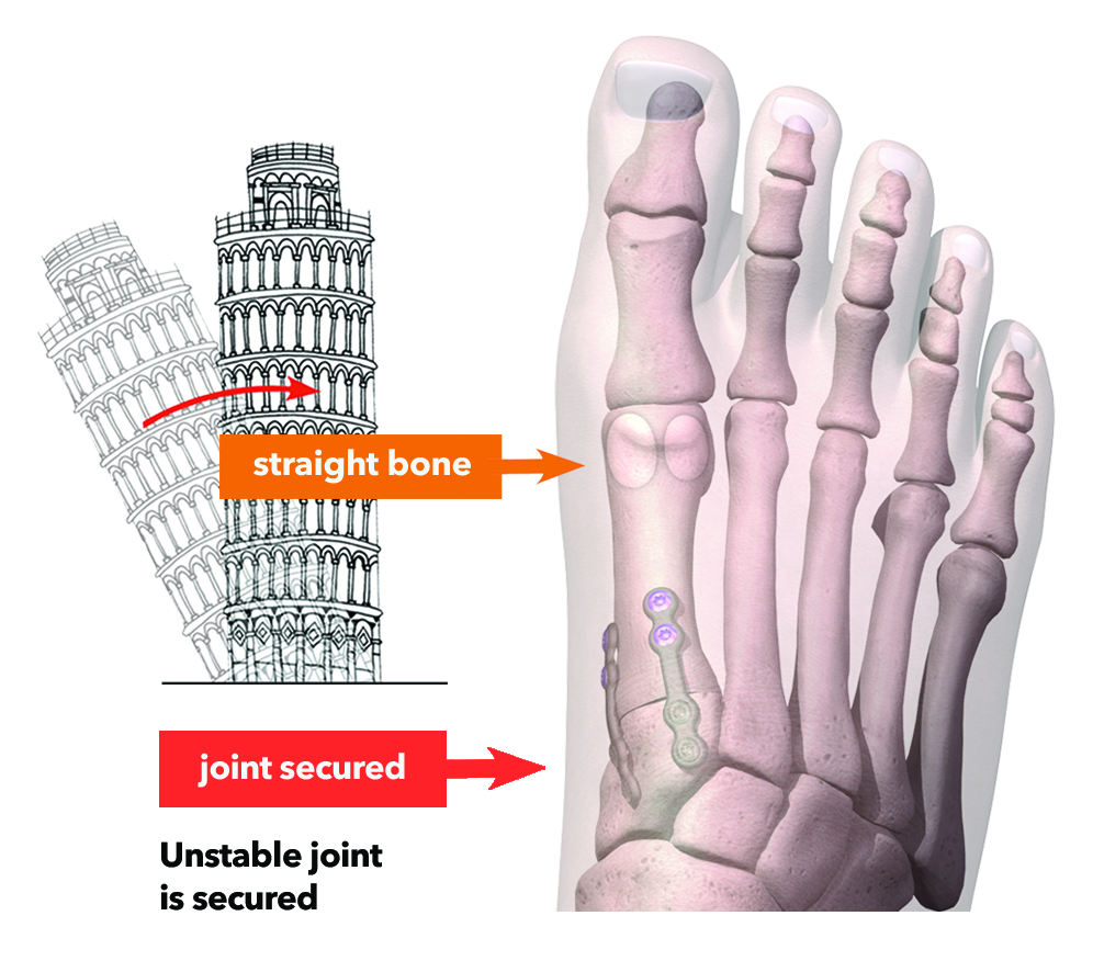 Illustration of straight foot bones after Lapiplasty® 3D Bunion Correction surgery.
