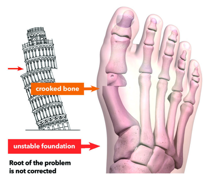 Illustration of crooked foot bones after traditional bunion surgery.