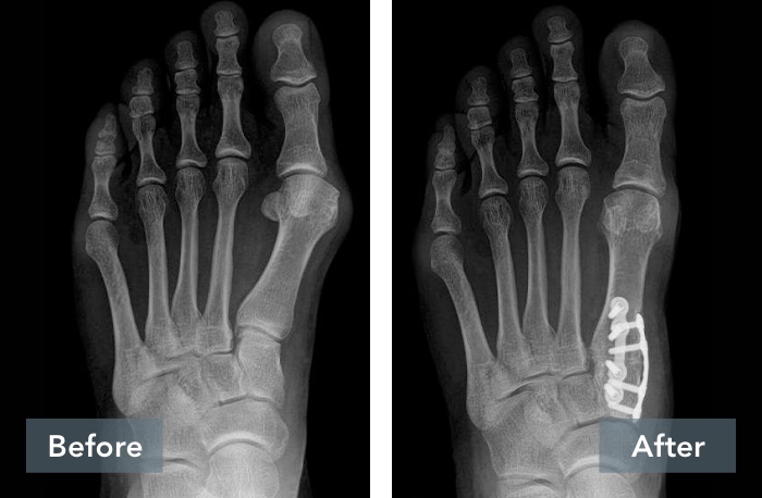 Patient x-rays before and six months after Lapiplasty® 3D Bunion Correction.