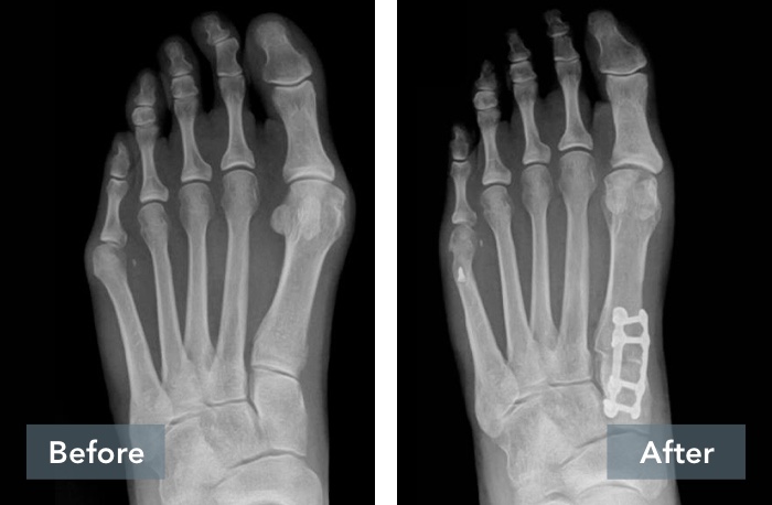 Before and after patient x-rays of a Lapiplasty Bunion Correction.