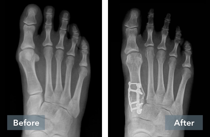 Before and after patient x-rays of a Lapiplasty® 3D Bunion Correction.