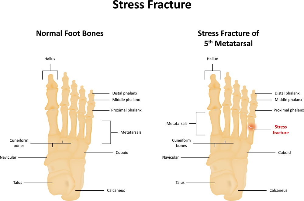 Stress Fracture Advanced Foot Care