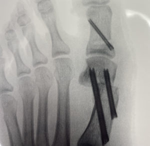 Minimally Invasive Surgery - Foot