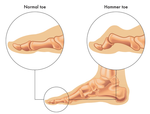 Hammertoe Correction - Advanced Foot Care