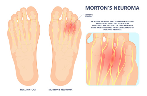 Neuroma and Nerve Pain - Advanced Foot Care