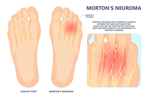 Treat Neuroma And Nerve Pain Podiatrist on Long Island