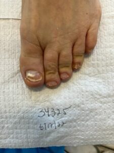 After 3 Months Laser Surgery - Advanced Foot Care