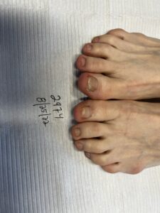 After Laser Fungus Removal Surgery - Advanced Foot Care