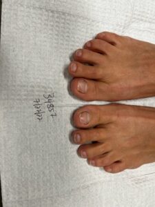After Laser Fungus Surgery- Advanced Foot Care