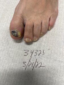 Before Laser Surgery Fungus Removal - Advanced Foot Care