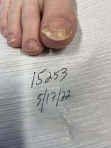 Before toenail laser surgery -Advanced Foot Care