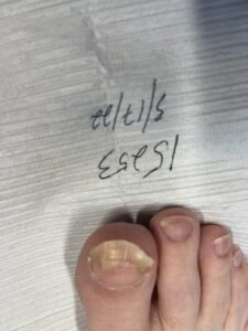 Before toenail laser surgery -Advanced Foot Care