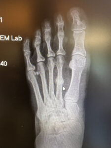 After Fracture Care - Advanced Foot Care