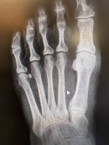 Before Fracture Care - Advanced Foot Care