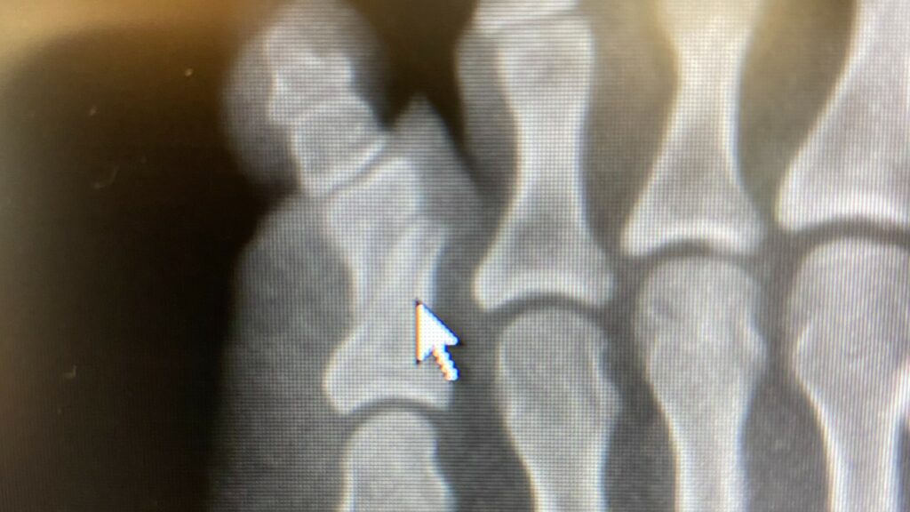 broken toe x-ray