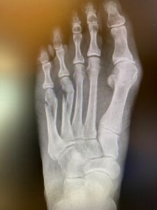 metatarsal