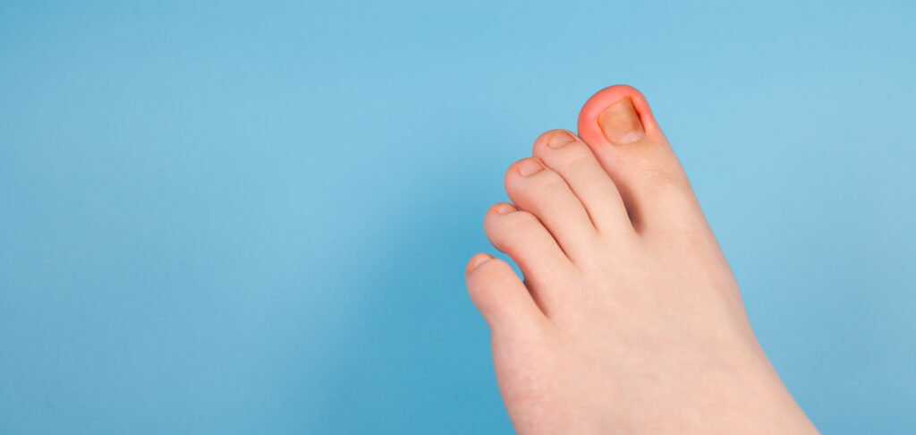 Ingrown toenails