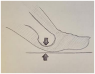 intractable plantar keratosis.