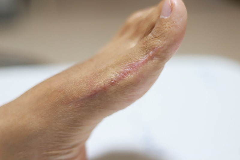 Cosmetic Foot Surgery