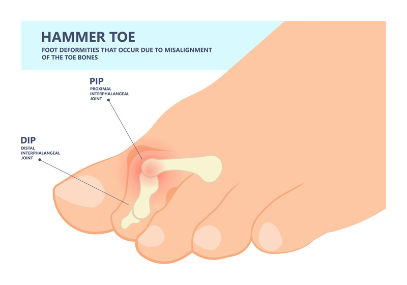 Hammertoe Diagram - Advanced Foot Care