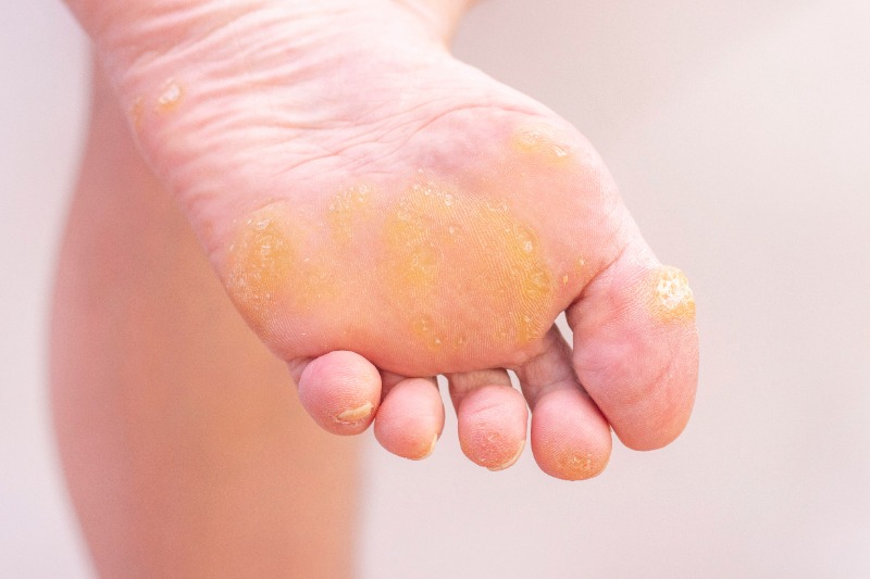 Warts - Advanced Foot Care