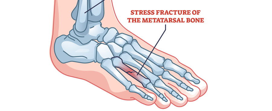 Stress Fractures