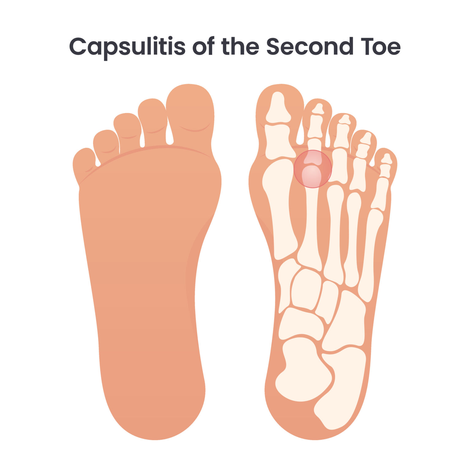 Understanding Capsulitis of the Second Metatarsophalangeal Joint ...