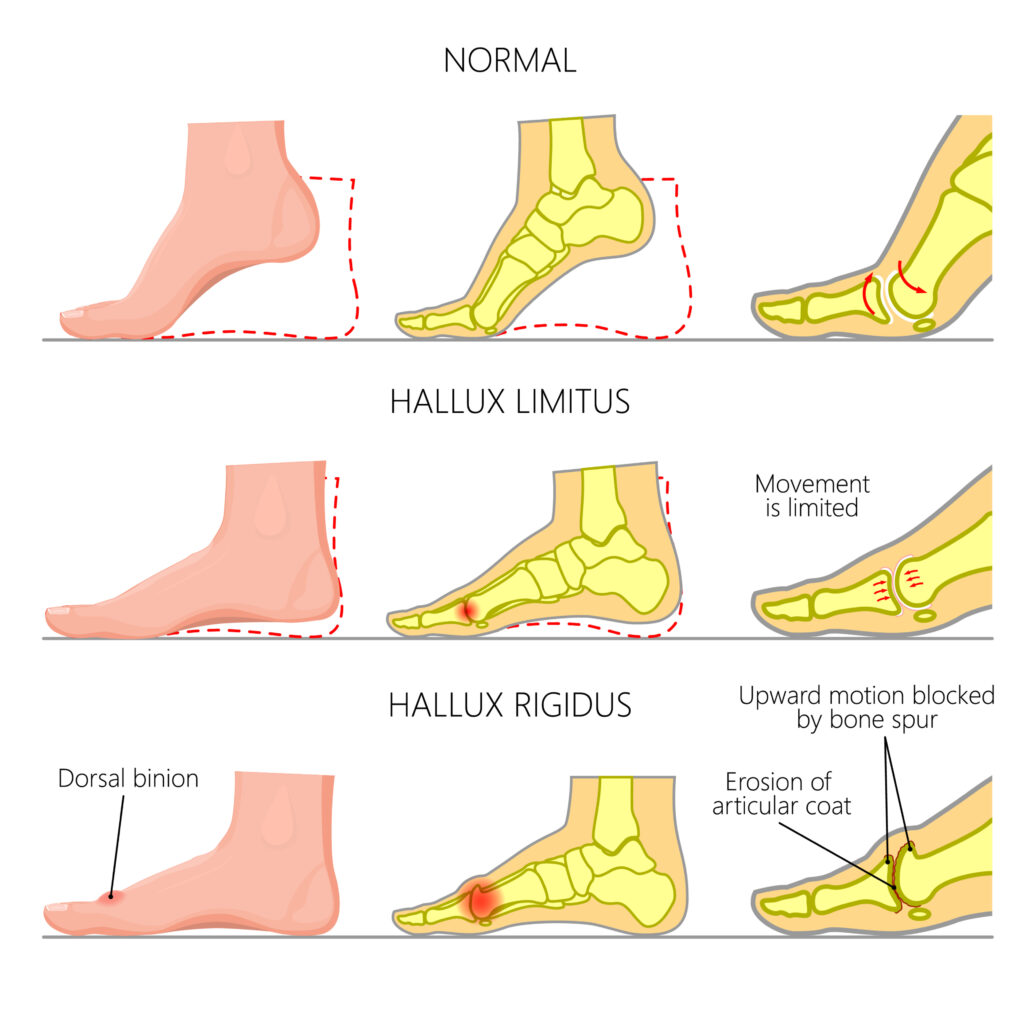 Hallux 