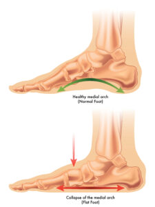 flat feet