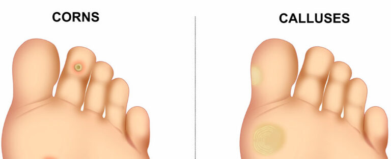 What Is the Difference Between a Corn and a Callus? - Advanced Foot Care