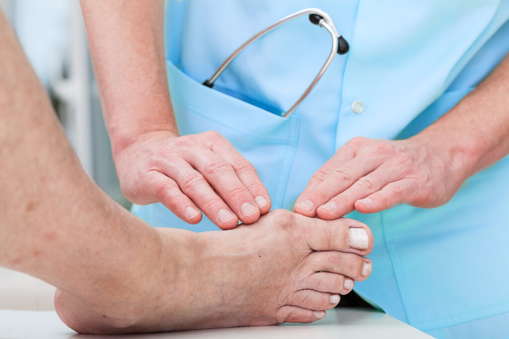 Minimially invasive bunion treatment
