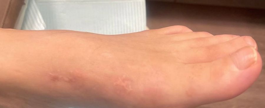 Bunion Surgery