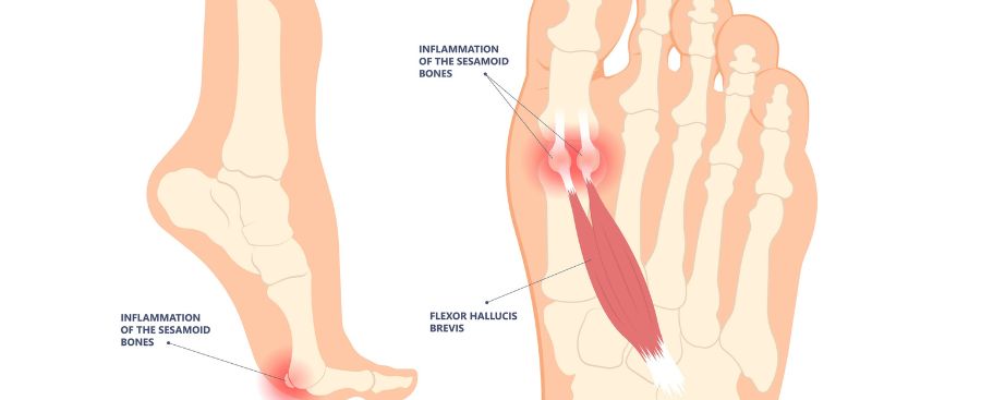 Sesamoid Injury