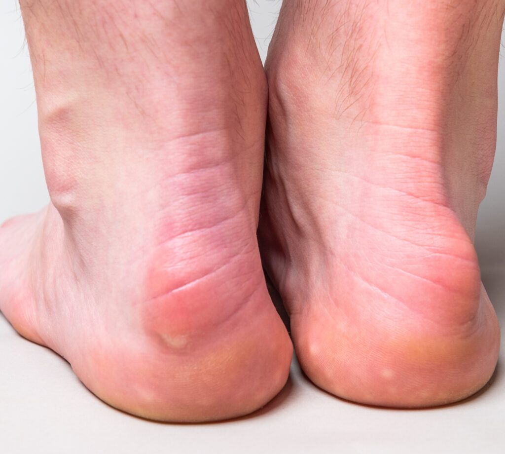 Haglund’s Deformity 