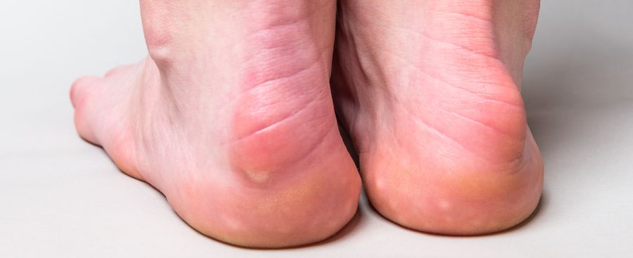 Haglund’s Deformity Treatment