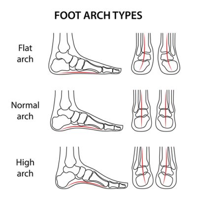 Flat and High Arched Feet - Advanced Foot Care