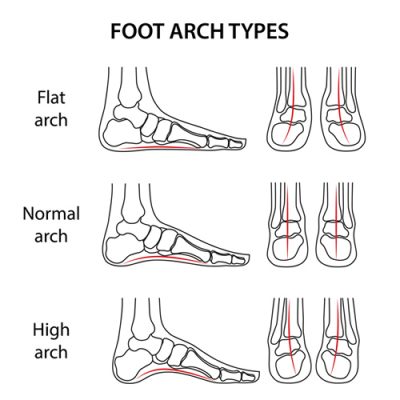 Treat Flat And High Arched Feet