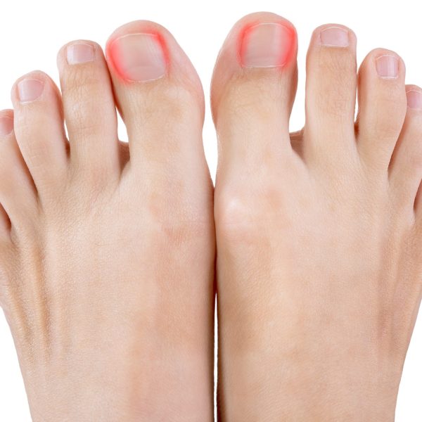 Ingrown toenails