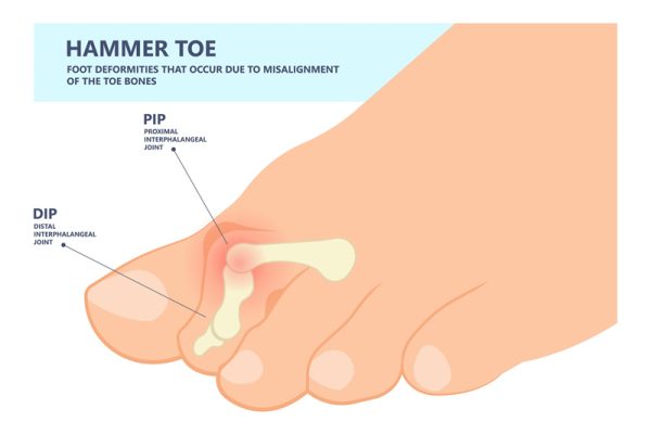 hammertoe podiatrist Long Island NY